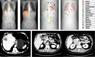 Predicting immunotherapy outcomes in patients with MSI tumors using NLR and CT global tumor volume